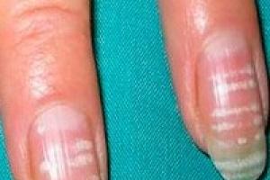 Белые пятна на ногтях пальцев рук: причины Белые точки на ногтях чего не хватает